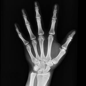 An Xray Of Five fingers
